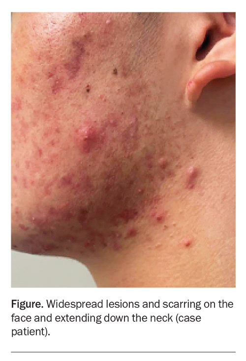 A Teenager With Facial Papules And Pustules Medicine Today